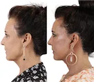 Before and after facelift side profile comparison.