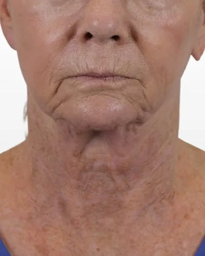 Close-up of a person's lower face and neck area.