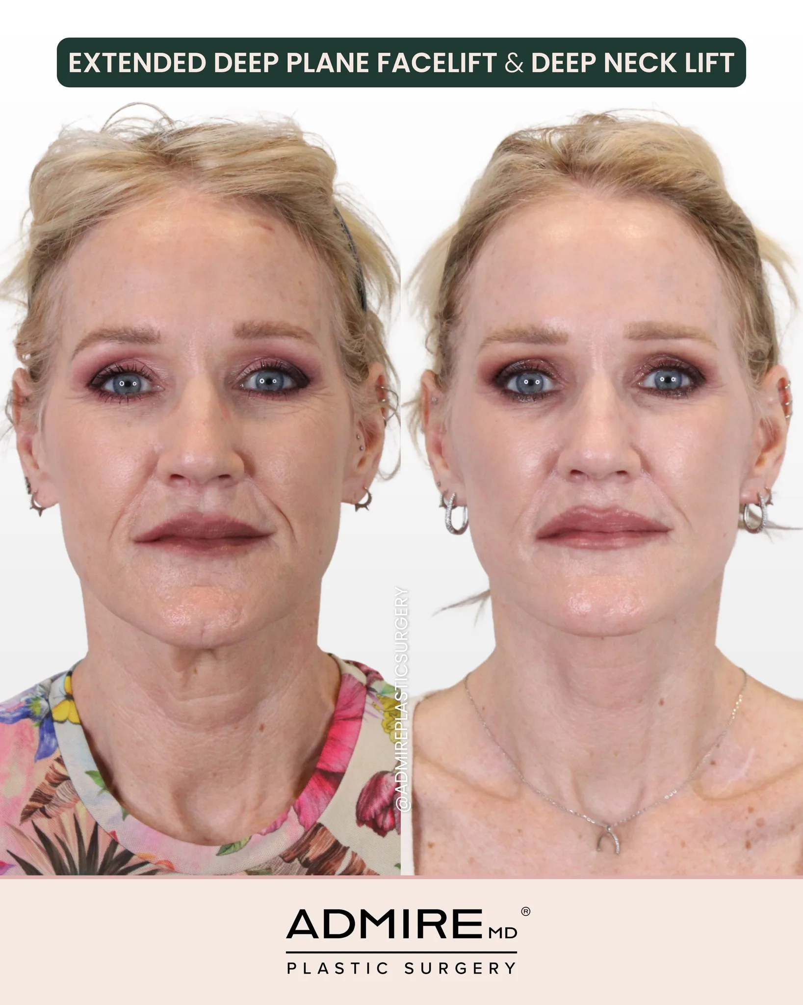 Before and after extended deep plane facelift and neck lift.