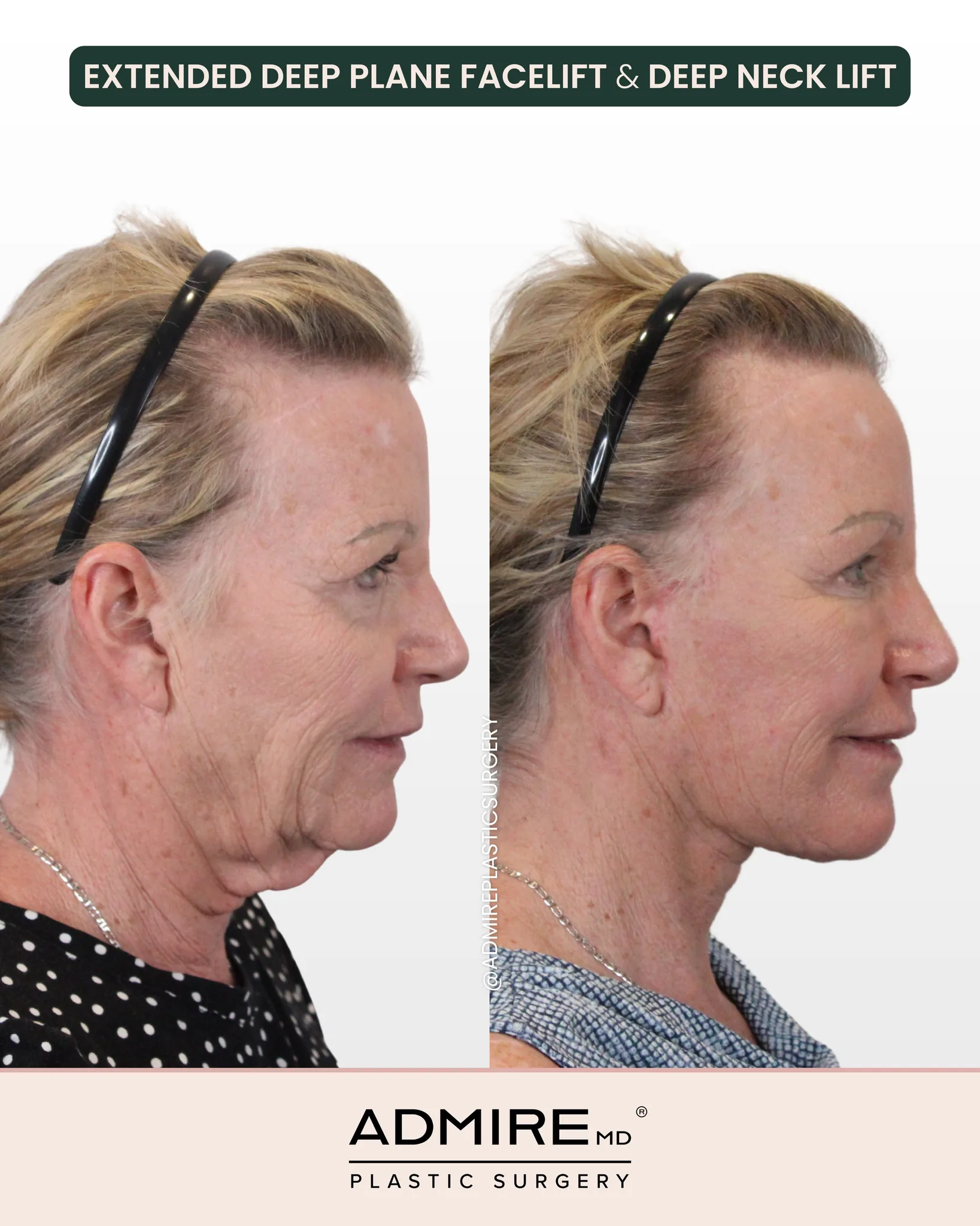 Before and after profile view of a facelift