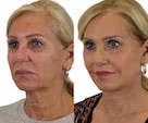 Before-and-after facial treatment comparison of a woman.
