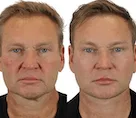 Before and after cosmetic procedure photos of a male subject.