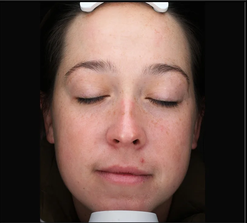 A woman with closed eyes after an aesthetic treatment.