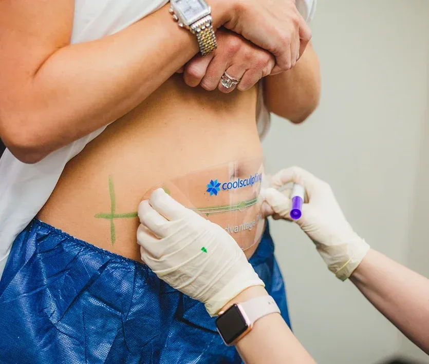 A technician applying coolsculpting to a client's midsection.