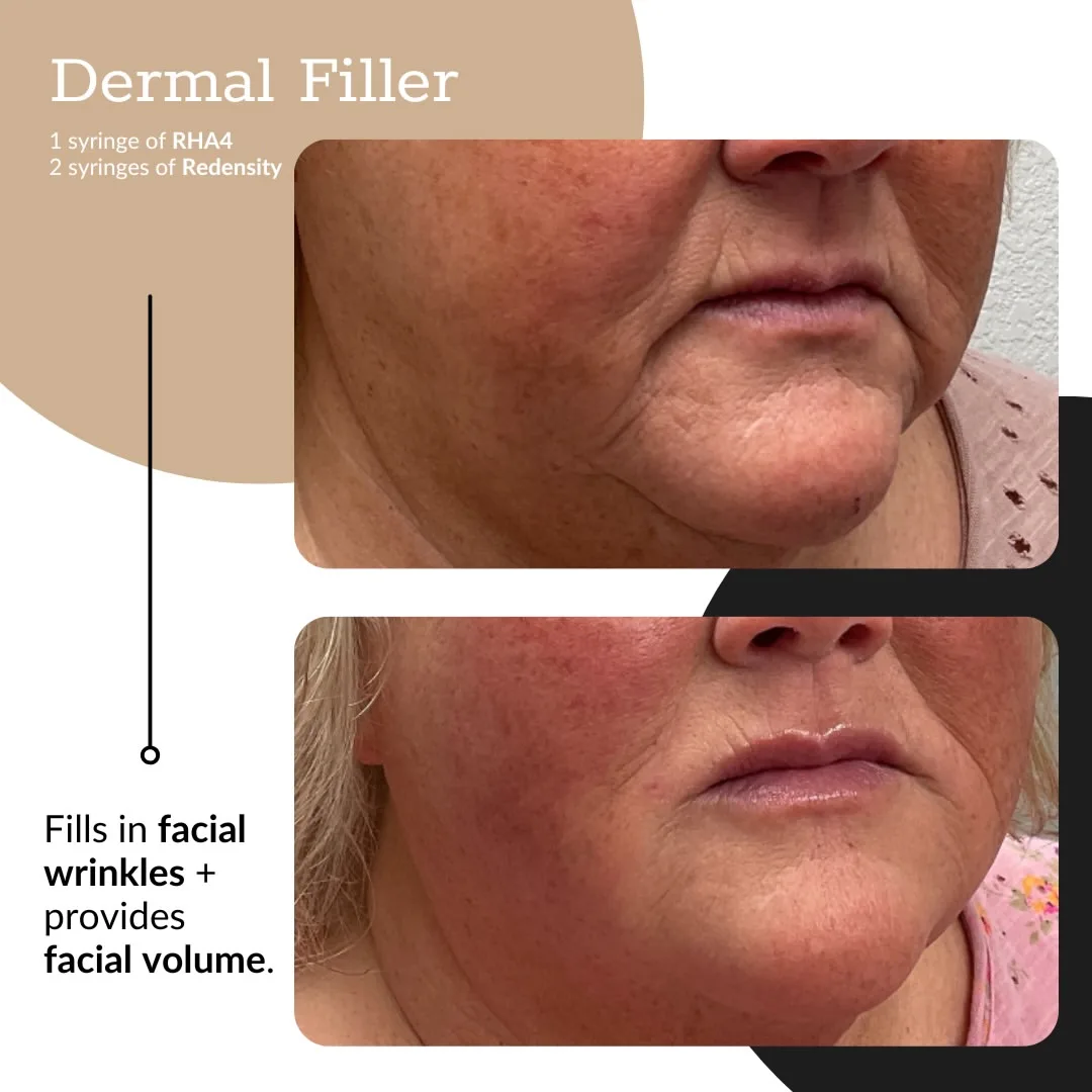 Before and after dermal filler treatment illustration.