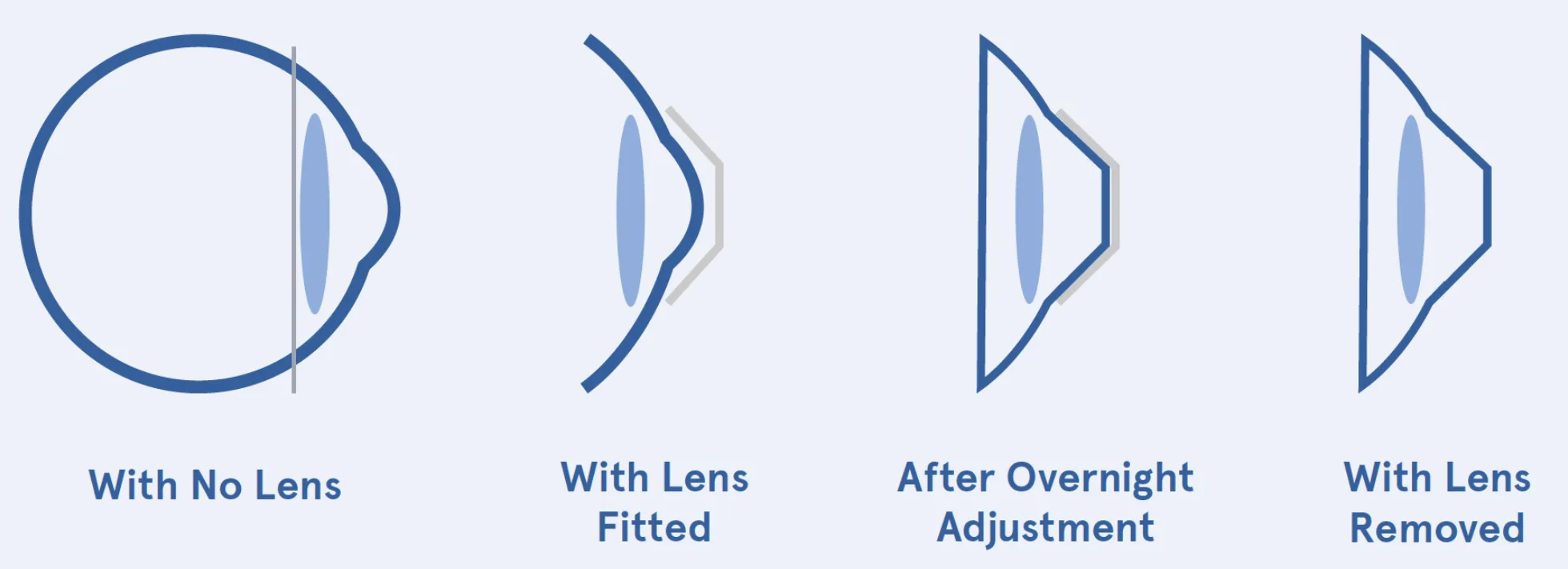 Diagram of orthokeratology effects on the eye.