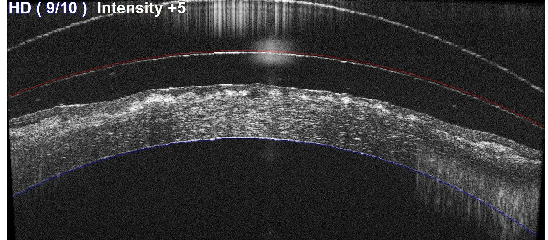 OCT scan showing corneal dystrophy layers.