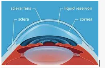 Diagram of an eye with a scleral contact lens and labeled parts.
