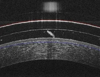 OCT scan showing protective tear reservoir in filamentary keratitis.