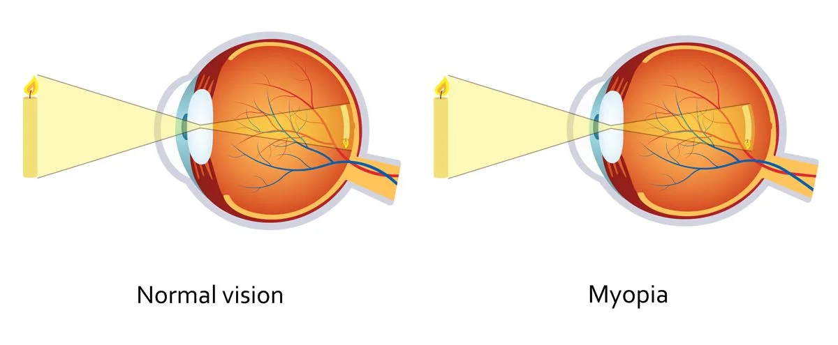 Comparison of normal vision and myopia in the eye.