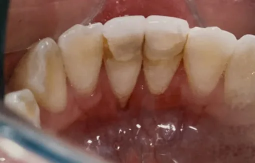 Close-up of healthy upper front teeth.
