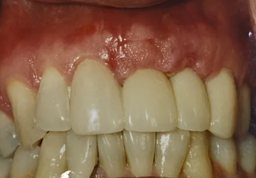 Close-up of a patient's teeth and gums.