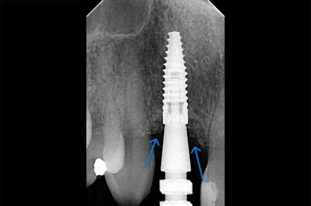 Dental implant X-ray with highlighted implant.
