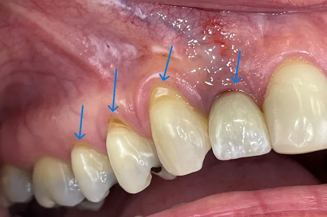 Close-up of gums and teeth with inflammation highlighted.