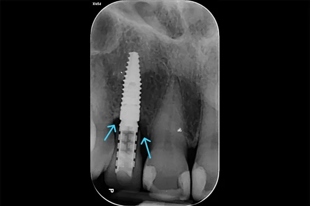 Dental X-ray showing an implant in the lower jaw.