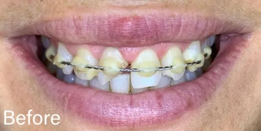 Close-up of teeth with braces labeled 'Before'.