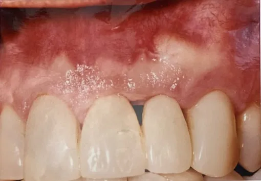 Close-up of gums and teeth showing inflammation.