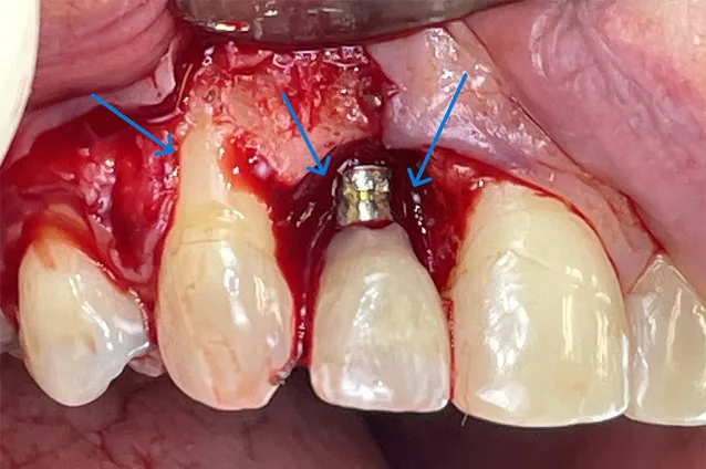Close-up of dental surgery with implant and adjacent teeth.