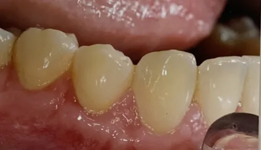 Close-up of healthy upper teeth and gums