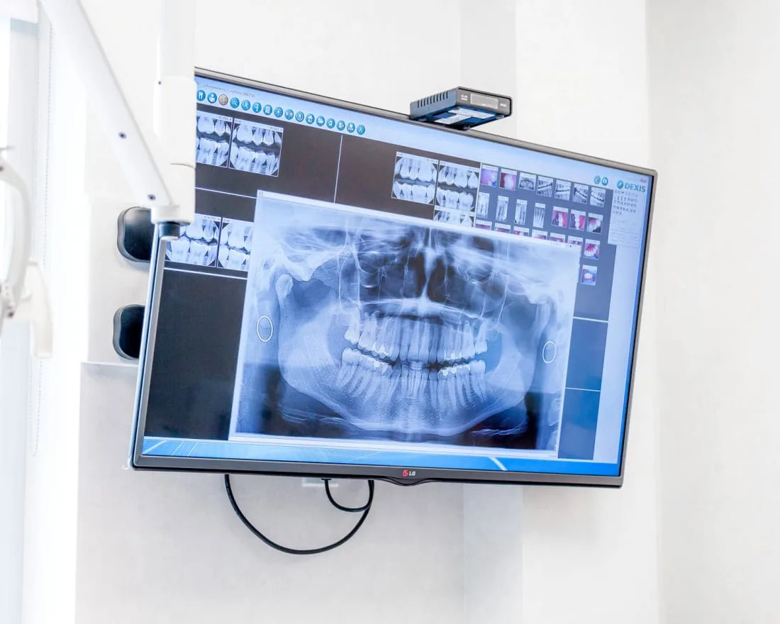 A dental X-ray displayed on a monitor in an office.