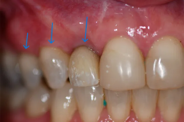 A close-up view of human teeth with arrows indicating specific areas.