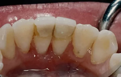 Close-up of upper front teeth in a dental examination.