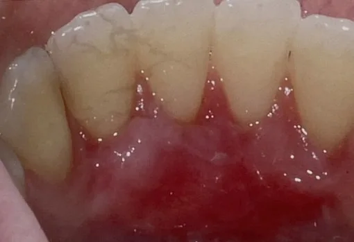 Close-up of upper front teeth and surrounding gums.