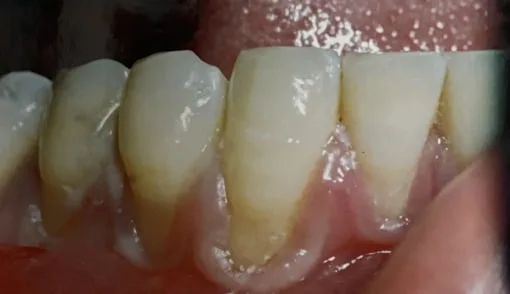 Close-up of human teeth and gums in need of care.