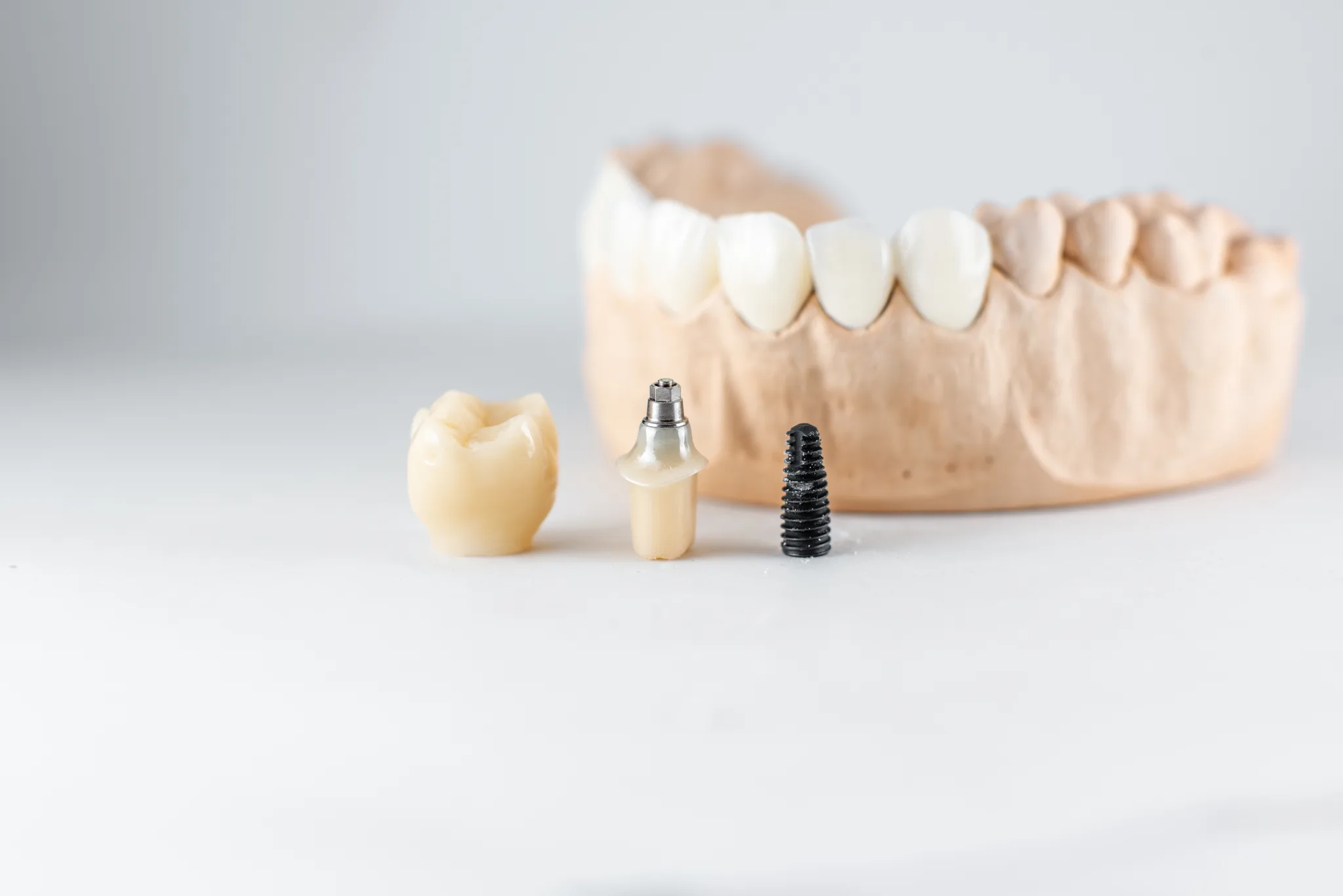 Model of artificial jaw with dental implants and components