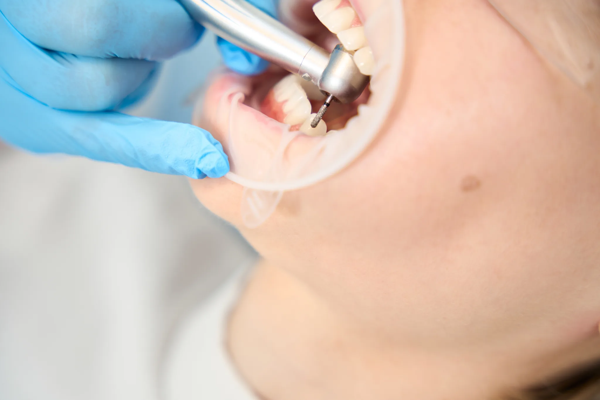 A dental drill in use on a patient's teeth.