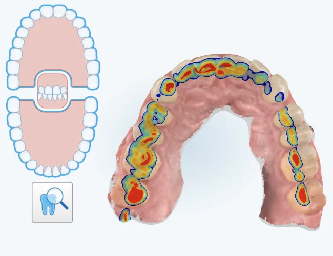 Digital dental scanner displaying a 3D model of teeth.