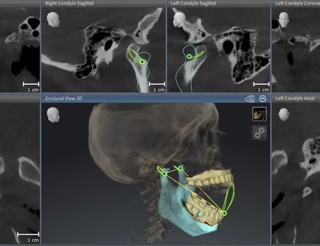 Dental imaging software displaying 3D skull and jaw models.