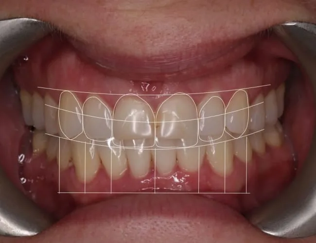 Close-up of a patient's teeth with overlay grid.