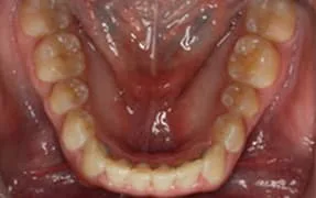 Close-up of lower teeth and gums