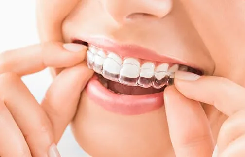A person placing a clear orthodontic aligner on their teeth.