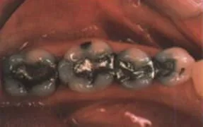 Close-up view of decayed molars and amalgam fillings.