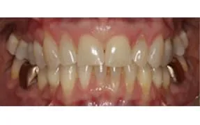 Close-up of a person's teeth after dental treatment