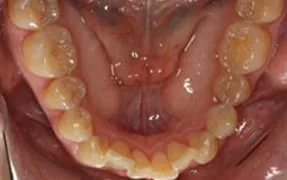 Close-up of dental arches with visible teeth and gums.