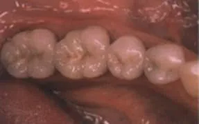 Close-up of healthy human molars with visible grooves.