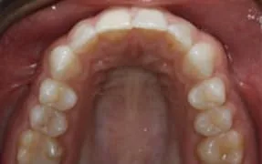 Close-up of a healthy upper dental arch with teeth.