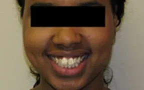 Young woman with a bright smile and straight teeth.