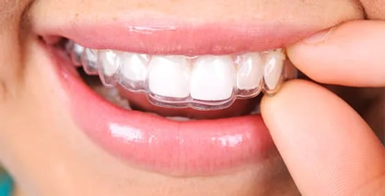A person removing clear teeth aligners from their mouth.