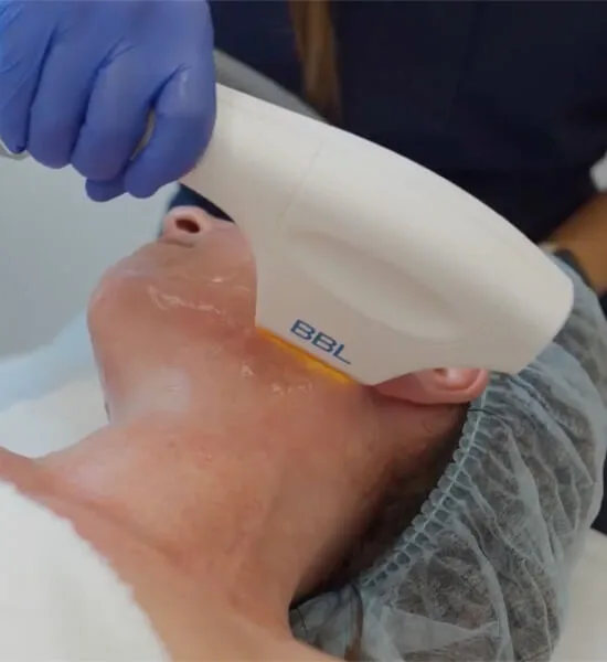 A woman undergoing BBL treatment on her neck.